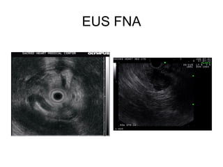 EUS FNA 