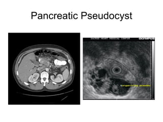Pancreatic Pseudocyst 