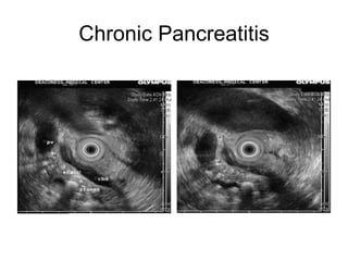 Chronic Pancreatitis 