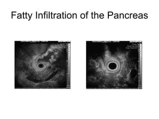 Fatty Infiltration of the Pancreas 