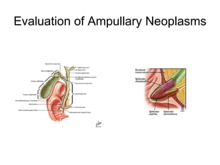 Evaluation of Ampullary Neoplasms 