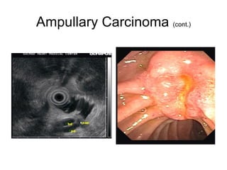 Ampullary Carcinoma  (cont.) 