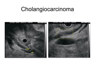 Cholangiocarcinoma 