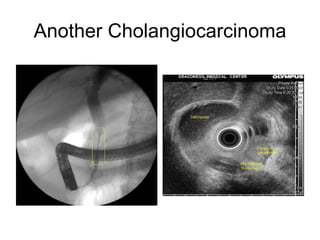 Another Cholangiocarcinoma 