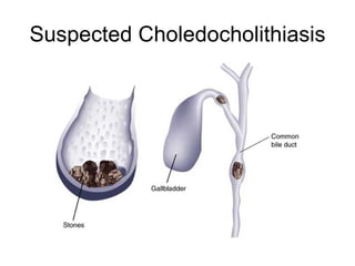 Suspected Choledocholithiasis 