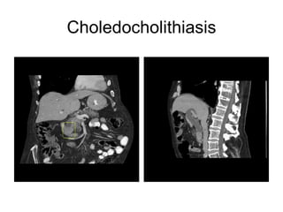 Choledocholithiasis 