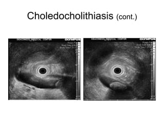 Choledocholithiasis  (cont.) 