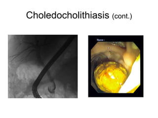 Choledocholithiasis  (cont.) 
