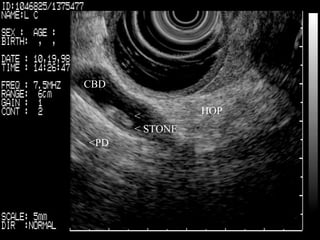 CBD   <  < STONE   <PD   HOP   