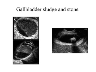 Gallbladder sludge and stone   