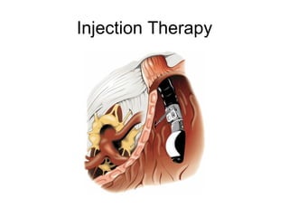 Injection Therapy 