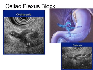 Celiac Plexus Block 
