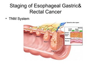 Staging of Esophageal Gastric& Rectal Cancer TNM System 