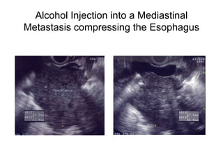 Alcohol Injection into a Mediastinal Metastasis compressing the Esophagus 
