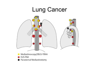 Lung Cancer 