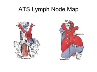 ATS Lymph Node Map 