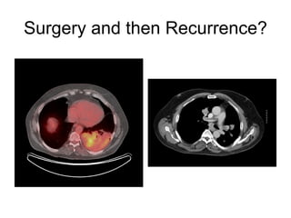 Surgery and then Recurrence? 