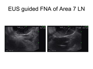 EUS guided FNA of Area 7 LN 