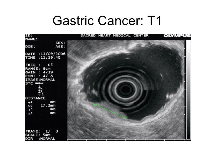 Git Endoscopic Ultrasound.