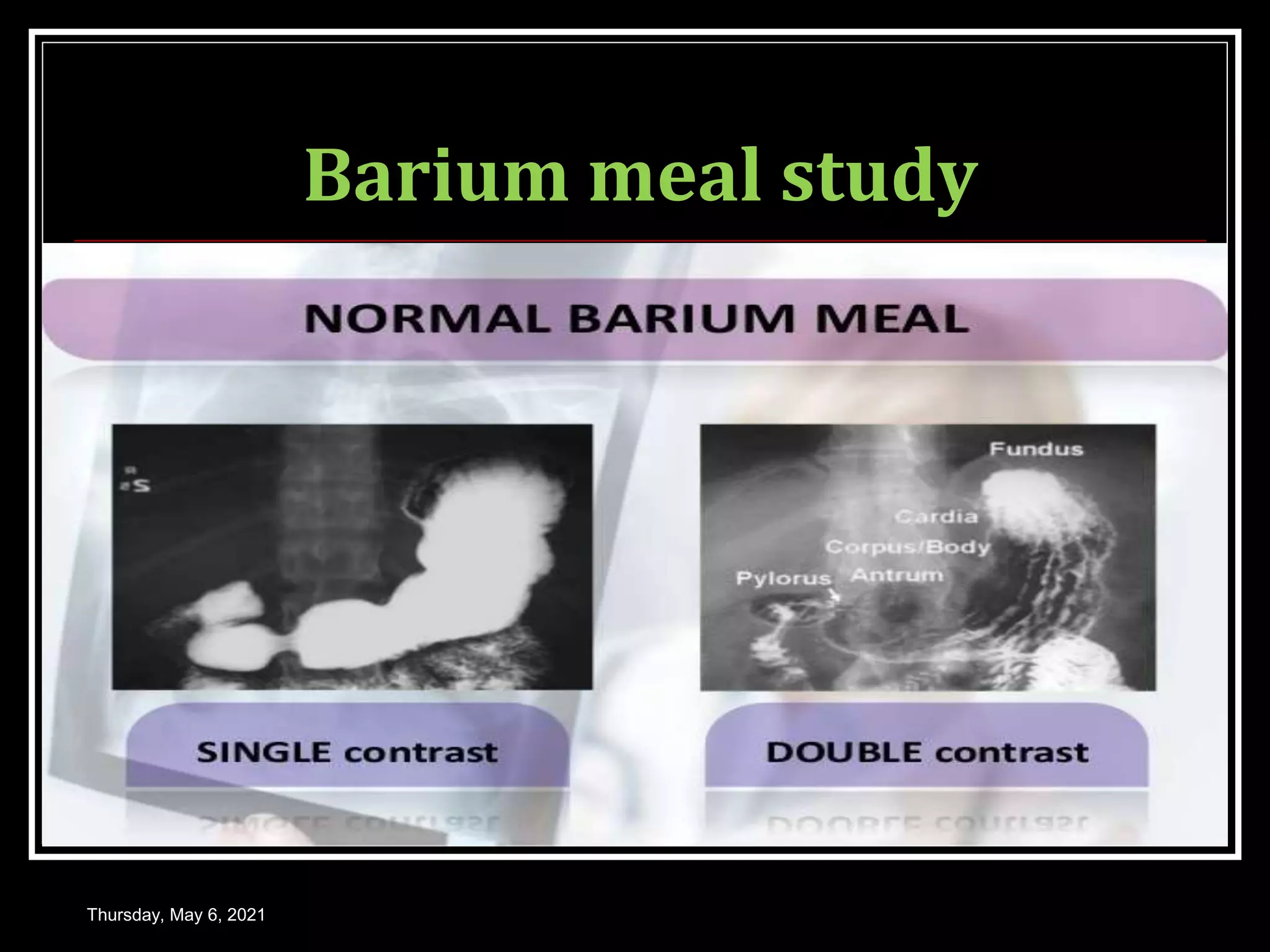 Barium meal study
Thursday, May 6, 2021
 