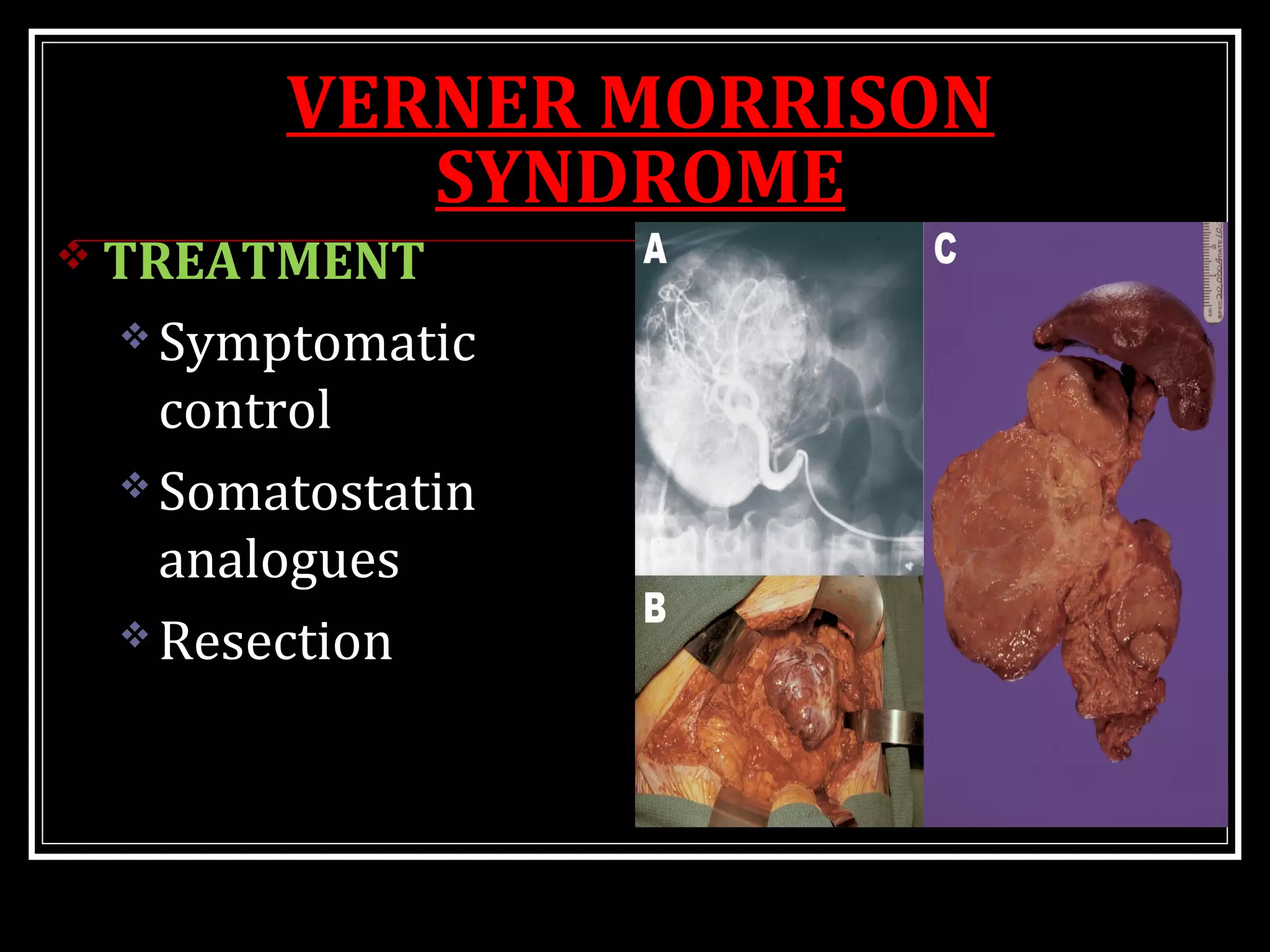 VERNER MORRISON
SYNDROME
 TREATMENT
 Symptomatic
control
 Somatostatin
analogues
 Resection
 