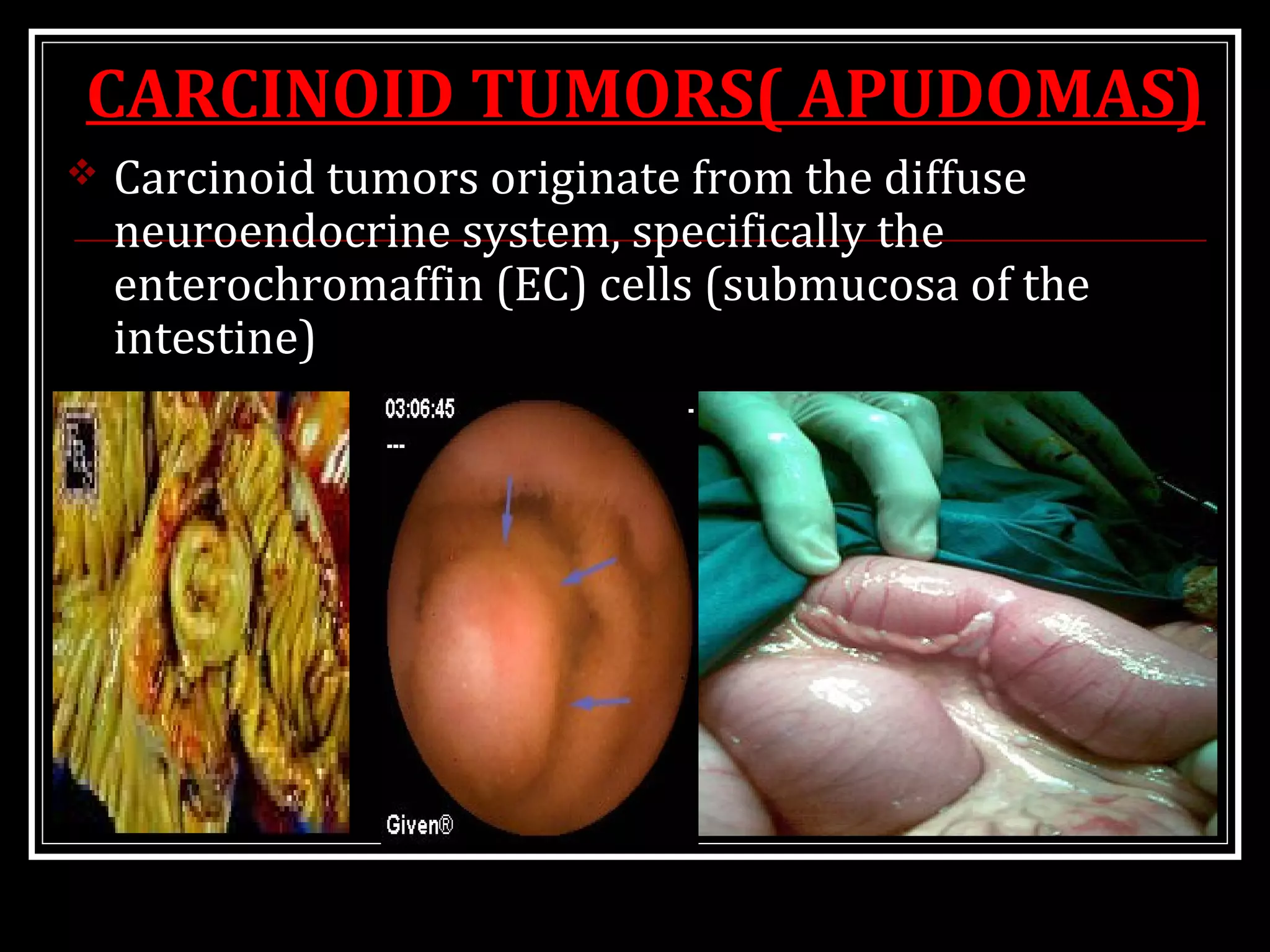 CARCINOID TUMORS( APUDOMAS)
 Carcinoid tumors originate from the diffuse
neuroendocrine system, specifically the
enterochromaffin (EC) cells (submucosa of the
intestine)
 