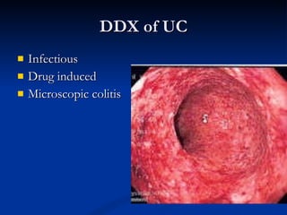 DDX of UC Infectious Drug induced Microscopic colitis 
