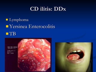 CD ilitis: DDx Lymphoma Yersinea Enterocolitis  TB 