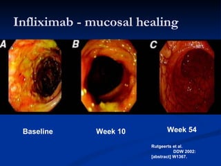 Infliximab - mucosal healing Baseline Week 10 Week 54 Rutgeerts et al.  DDW 2002: [abstract] W1367. 