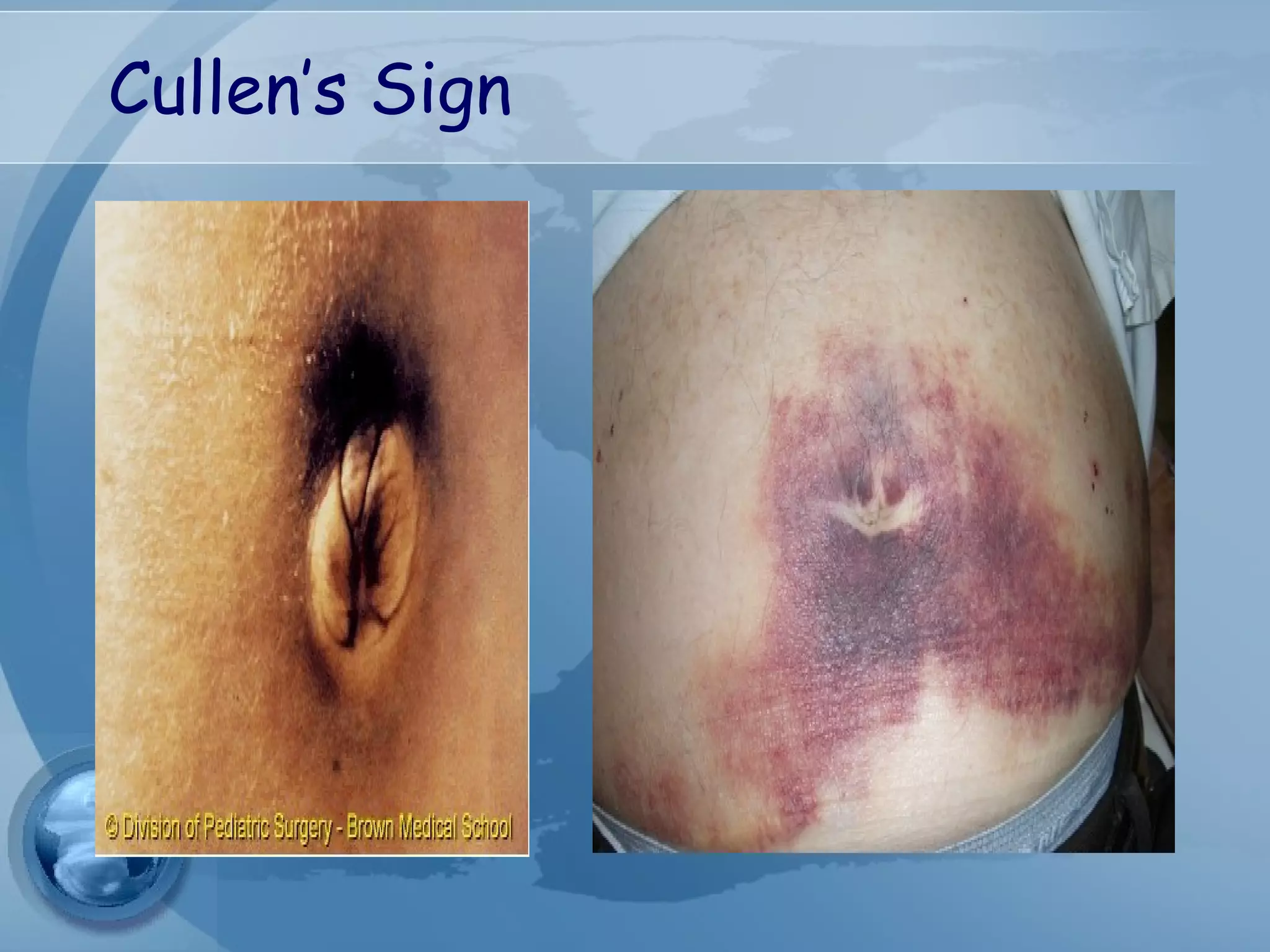 Cullen’s Sign
 