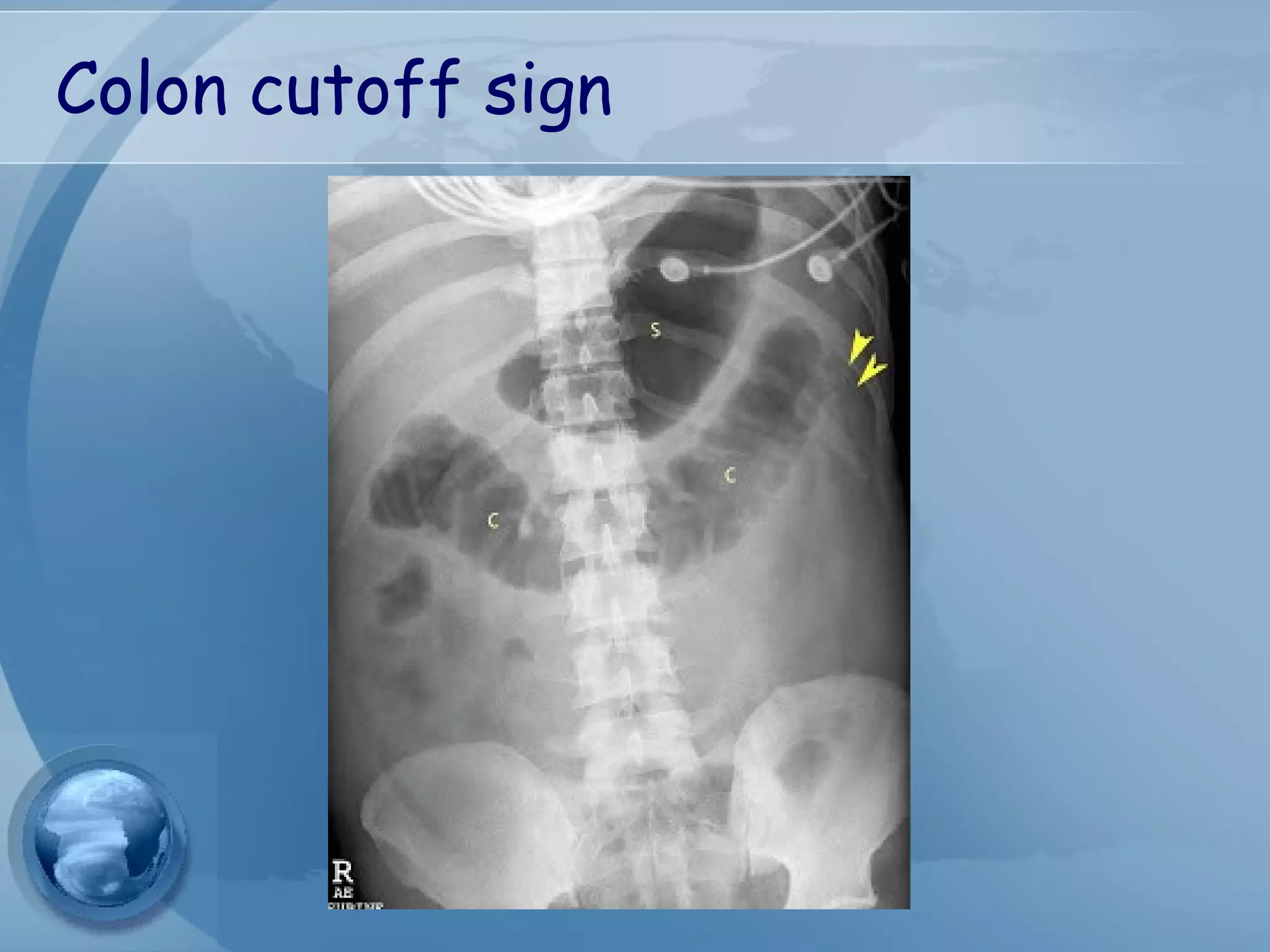 Colon cutoff sign
 