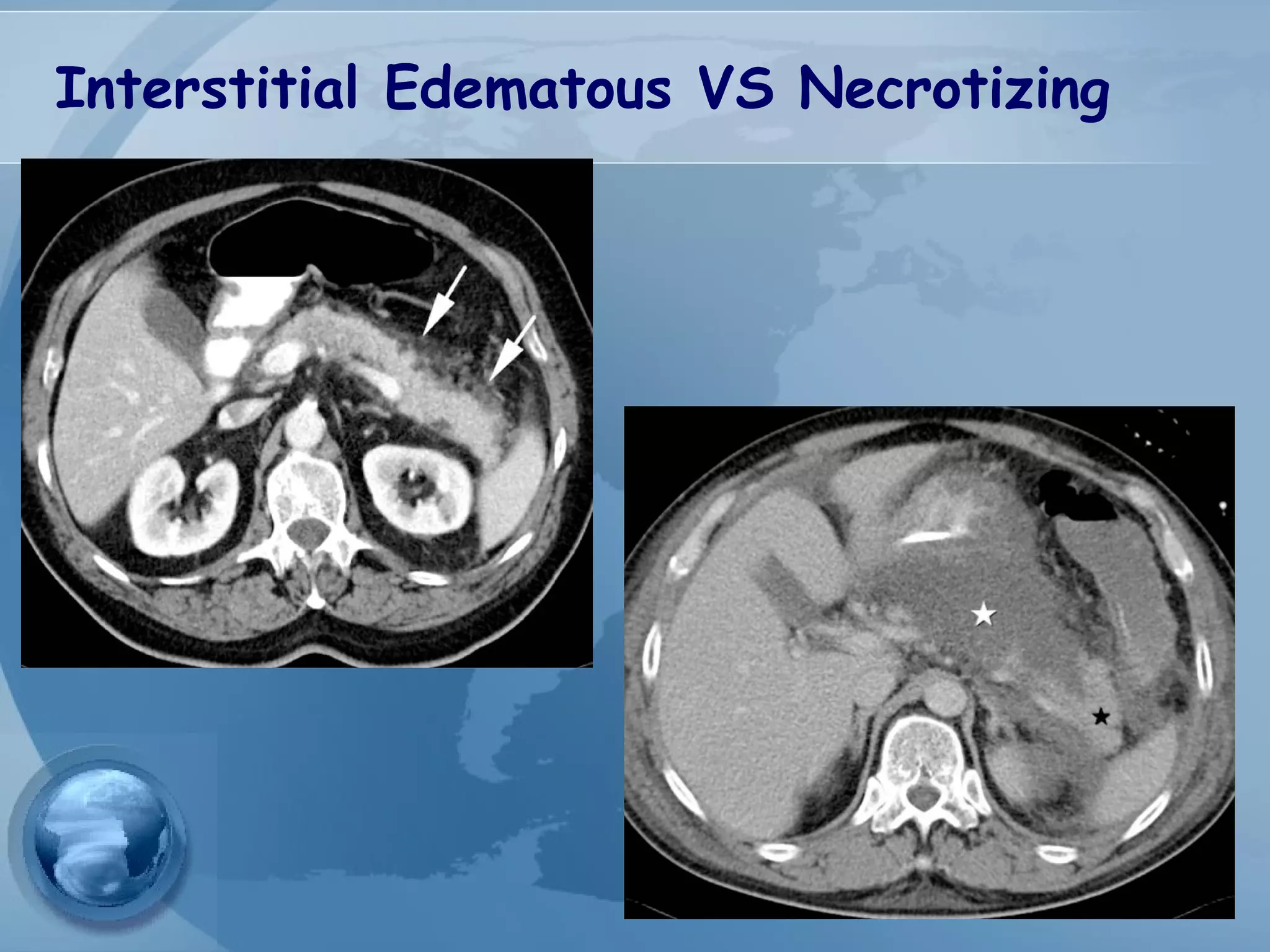 Interstitial Edematous VS Necrotizing
 