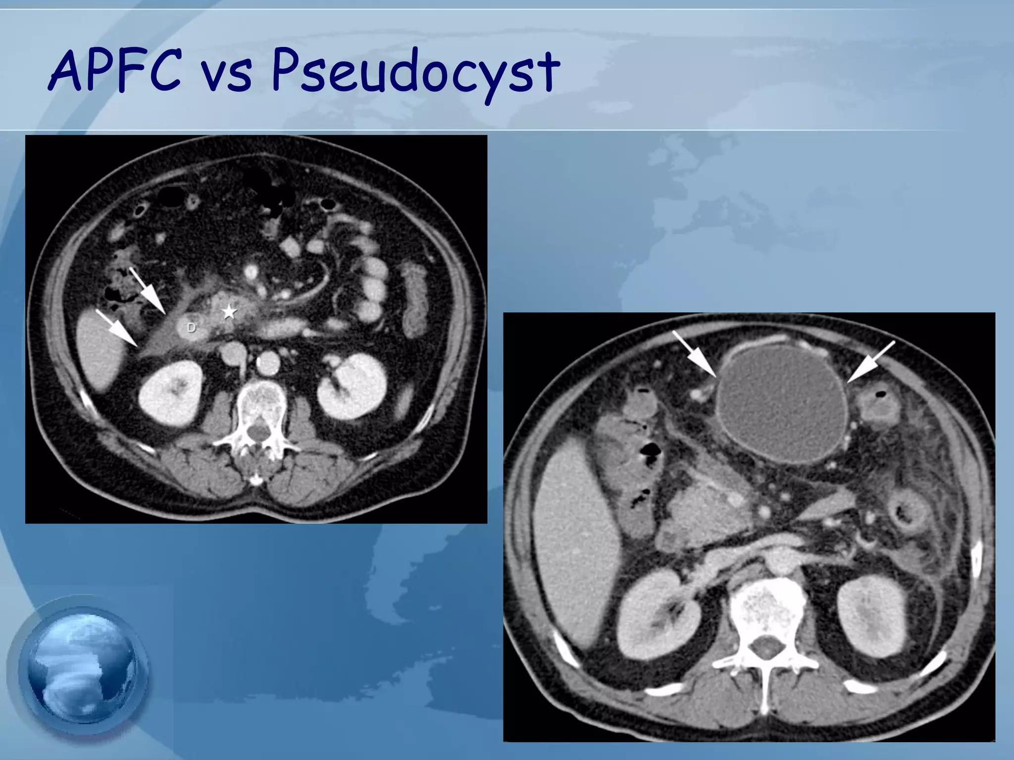 APFC vs Pseudocyst
 