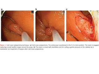 GIT j club cold polyp snaring.