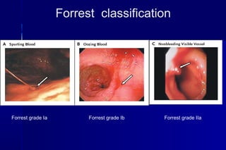 Forrest grade Ia Forrest grade Ib
Forrest classification
Forrest grade IIa
 