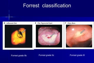 Forrest grade IIc Forrest grade III
Forrest classification
Forrest grade IIb
 