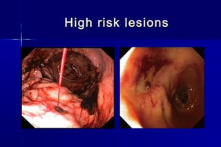 High risk lesionsHigh risk lesions
 