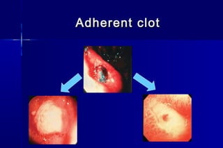 Adherent clotAdherent clot
 