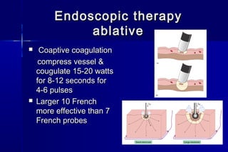 Endoscopic therapyEndoscopic therapy
ablativeablative
 Coaptive coagulationCoaptive coagulation
compress vessel &compress vessel &
cougulate 15-20 wattscougulate 15-20 watts
for 8-12 seconds forfor 8-12 seconds for
4-6 pulses4-6 pulses
 Larger 10 FrenchLarger 10 French
more effective than 7more effective than 7
French probesFrench probes
 
