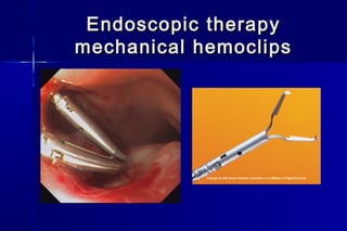 Endoscopic therapyEndoscopic therapy
mechanical hemoclipsmechanical hemoclips
 