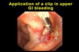 Application of a clip in upper
GI bleeding
 