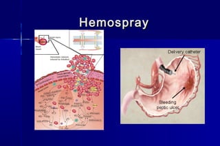HemosprayHemospray
 