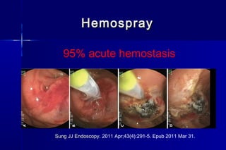 HemosprayHemospray
95% acute hemostasis
Sung JJ Endoscopy. 2011 Apr;43(4):291-5. Epub 2011 Mar 31.
 