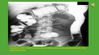 10/29/2023
11
Ulcerative colitis. Double-contrast barium enema study shows pseudopolyposis of the
descending colon
 