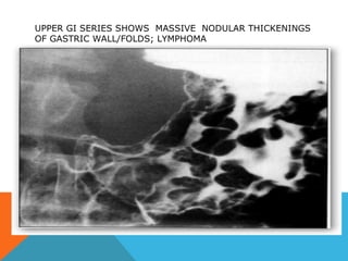 UPPER GI SERIES SHOWS MASSIVE NODULAR THICKENINGS
OF GASTRIC WALL/FOLDS; LYMPHOMA
 