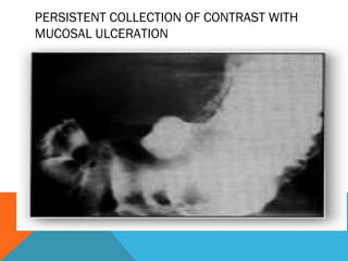 PERSISTENT COLLECTION OF CONTRAST WITH
MUCOSAL ULCERATION
 