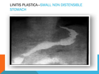 LINITIS PLASTICA—SMALL NON DISTENSIBLE
STOMACH
 