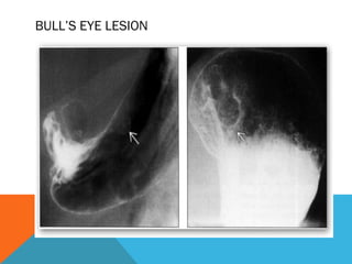 BULL’S EYE LESION
 