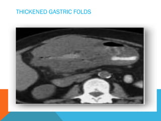 THICKENED GASTRIC FOLDS
 