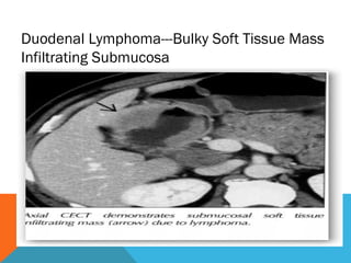 Duodenal Lymphoma---Bulky Soft Tissue Mass
Infiltrating Submucosa
 